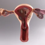 Hormone Replacement Therapy and the Path Forward for Managing PCOS in Pittsburgh, PA