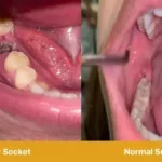 What to Expect During the Healing Process After Tooth Extraction